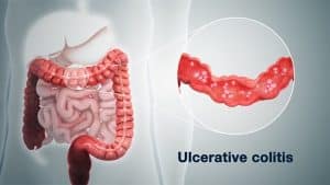 Treating Ulcerative colitis -Ayurveda Way